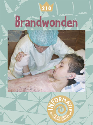 Brandwonden